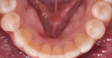 Veneers After