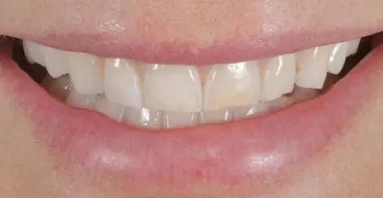 Veneers Before