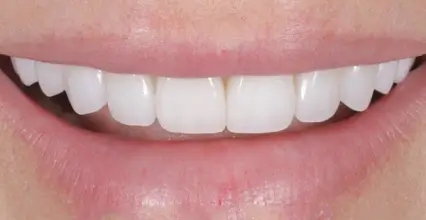 Veneers After