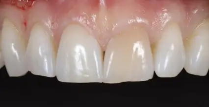 Veneers Before