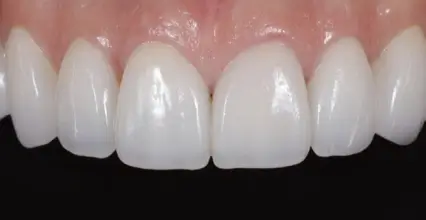 Veneers After