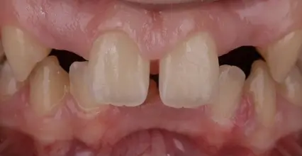 Veneers Before
