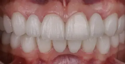 Veneers After