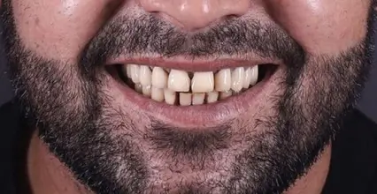 Invisalign Before