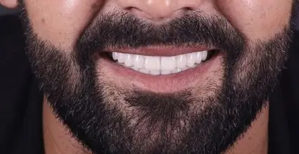 Invisalign After