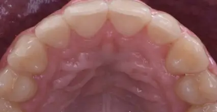 Invisalign After
