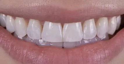 Braces Before