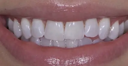 Braces After