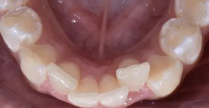 Braces Before