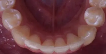 Braces After