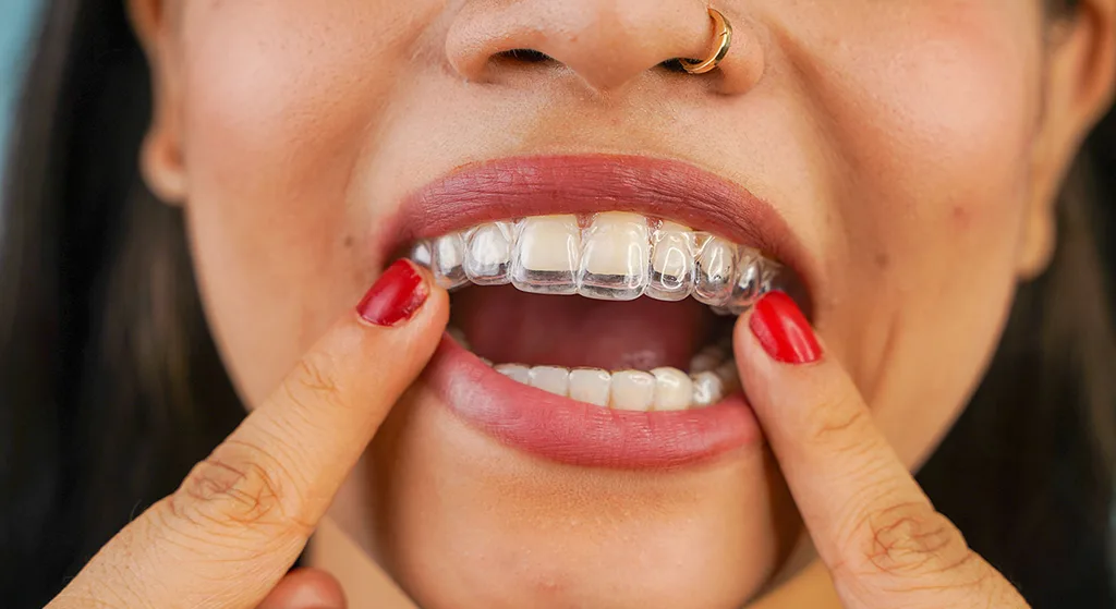 Diamond+ Invisalign Provider: What It Means for Your Orthodontic Care