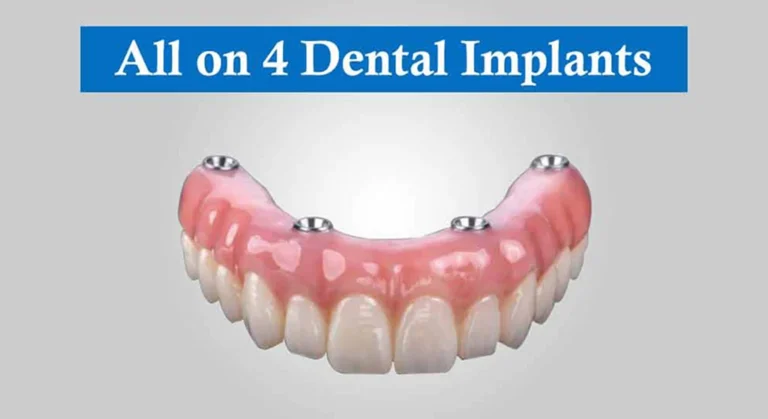 All-on-4 Dental Implants: A Permanent Solution for Missing Teeth