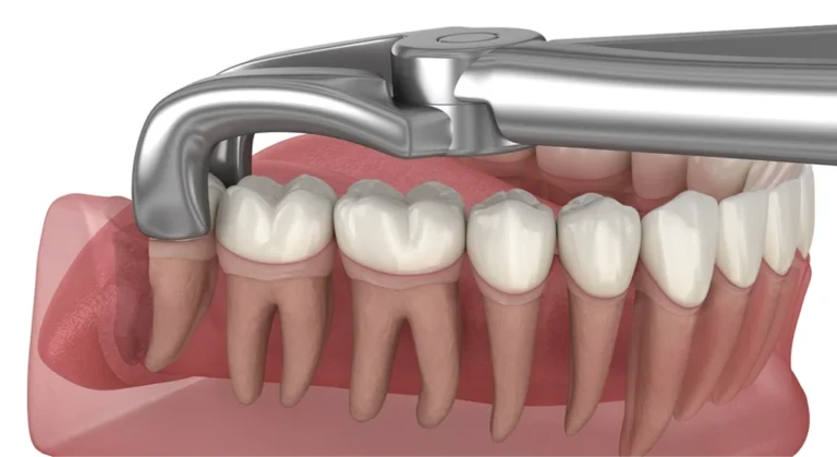 Wisdom Teeth Removal Elk Grove CA: Gentle Care and Modern Solutions for Your Comfort